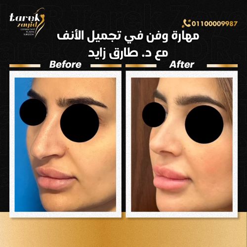 افضل دكتور تجميل انف في مصر 2026